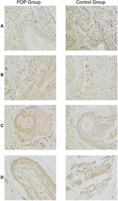 Expression of CD44, Transforming Growth Factor-β, and Matrix Metalloproteinases in Women With Pelvic Organ Prolapse